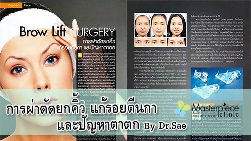 Brown Lift Surgery “การผ่าตัดยกคิ้ว แก้รอยตีนกา และปัญหาตาตก”  By Dr.Sae