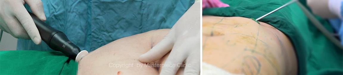 liposuction-masterpiececlinic01