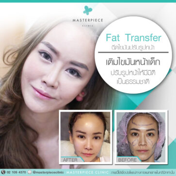 Fat Transfer เติมเต็มไขมันเพิ่มความอวบอิ่ม คืนความอ่อนเยาว์ - MasterPiece Clinic by Dr.Sae