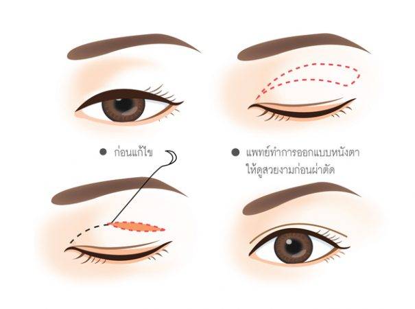 การรักษากล้ามเนื้อตาอ่อนแรงด้วยวิธีผ่าตัด