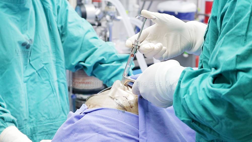 เปิดแผลผ่าตัด Open Rhinoplasty