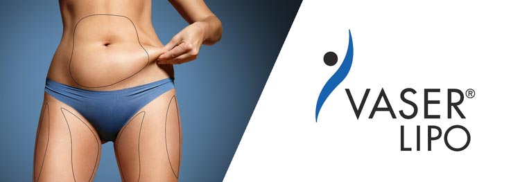 นวัตกรรม Vaser Liposuction 2.2